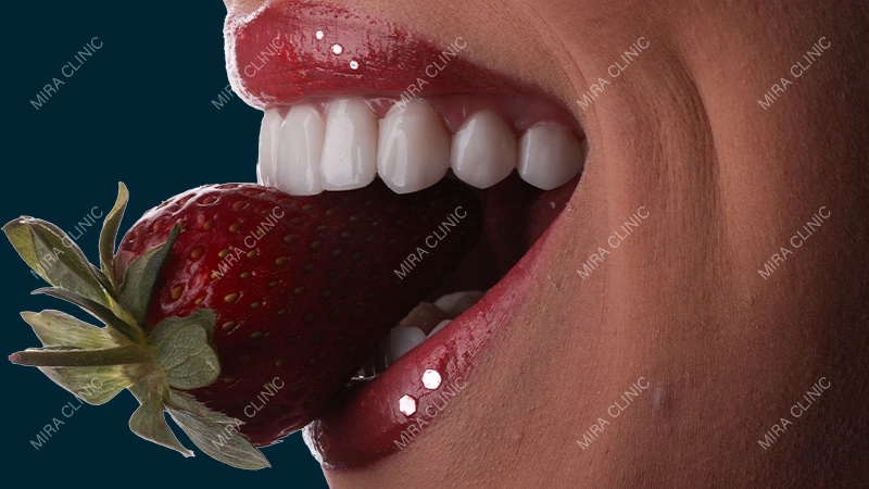 veneers